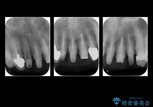 前歯のセラミック 神経の再治療からの治療中