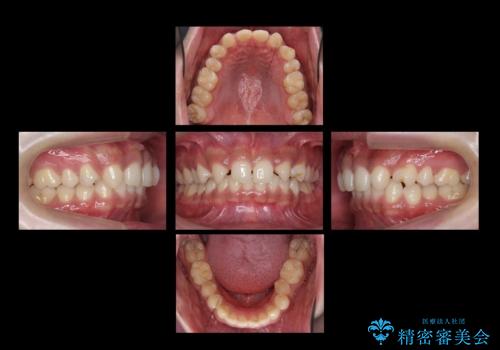 前歯のすきま 生まれつき歯が少ないのを治療の治療前
