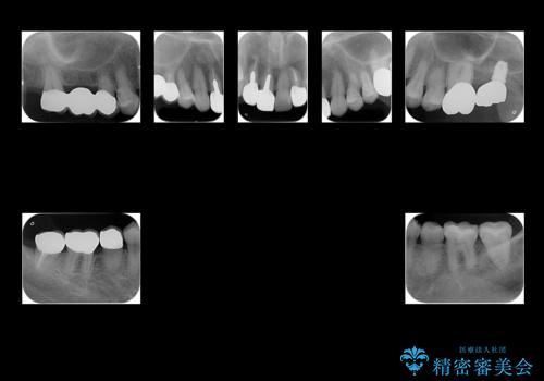 全体的な虫歯治療 他院で入れたインプラントの続きもの治療後