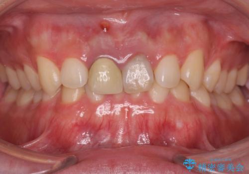 前歯の変色　神経のない歯の再治療の治療前