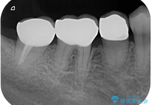 奥歯の高さがない 歯周外科で解決の治療後