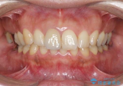 折れてしまった前歯   オールセラミックによる審美改善の治療後