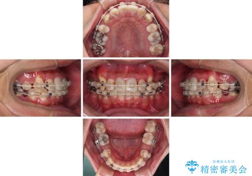 デコボコと変色した前歯　抜歯矯正と審美歯科治療の治療中