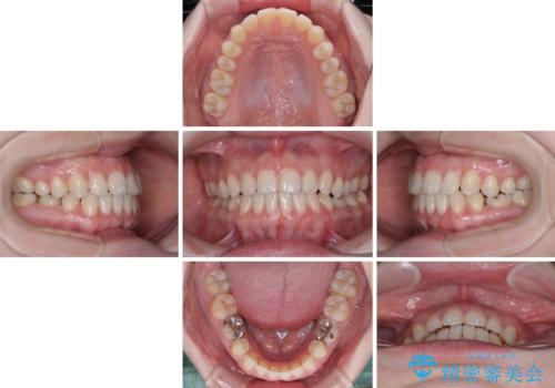 すきっ歯をインビザラインできれいな歯並びに改善の治療中