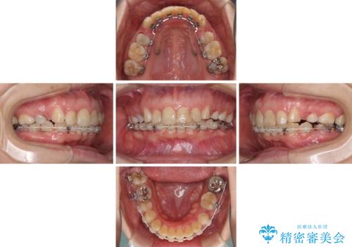 ハーフリンガルで歯列をきれいに　セラミック治療で気になる銀歯も自然な色にの治療中
