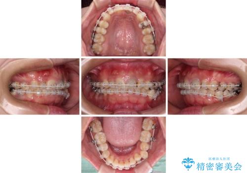 歯列から飛び出た歯 ワイヤー矯正で整った歯列にの治療中