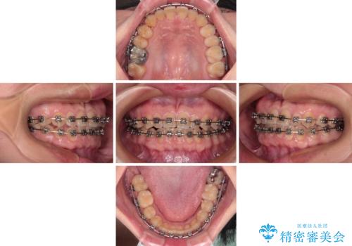 反対咬合を治したい ワイヤー装置で一気に咬み合わせを改善の治療中