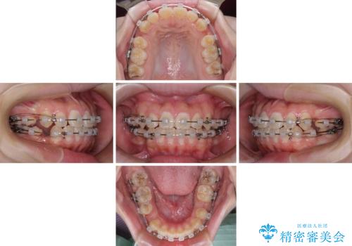 舌突出癖で出っ歯と開咬に　舌のトレーニングを行いながら抜歯矯正　の治療中