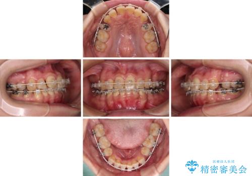 治療途中で帰国 装置をつけた状態を継続して矯正治療の治療中