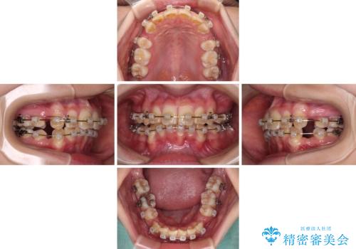 【モニター】出っ歯と八重歯　抜歯矯正でスッキリとした口元にの治療中