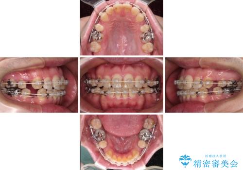 しゃくれて口が閉じられない ワイヤー装置での抜歯矯正の治療中