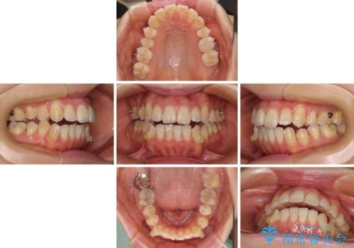 八重歯と開咬の抜歯矯正 ワイヤー装置を併用したインビザライン矯正治療の治療中