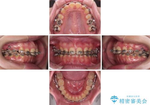 外科手術が必要と言えるほど突出した前歯 長期間をかけた抜歯矯正の治療中