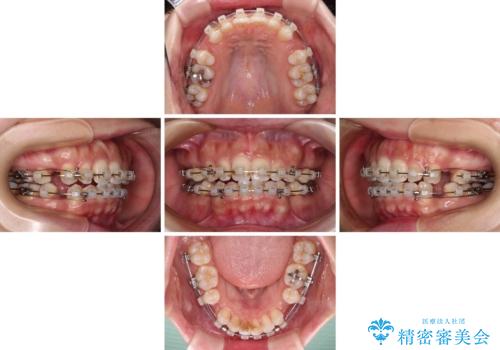 唇が閉じにくい ワイヤー装置での抜歯矯正の治療中