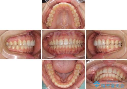インビザライン矯正で前歯のデコボコを改善の治療中