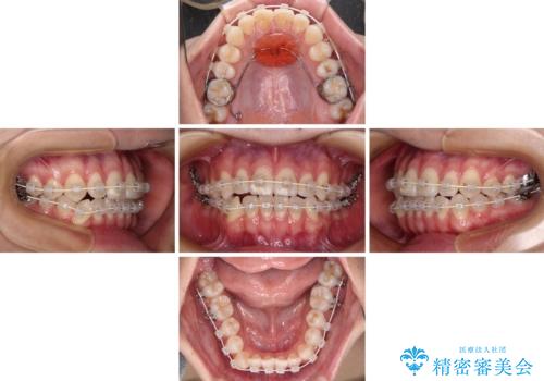 咬み合わせの乱れを改善 ワイヤー装置で楽々矯正治療の治療中