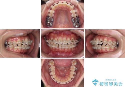 気になる八重歯 ワイヤー装置での非抜歯矯正の治療中