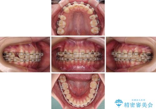 飛び出した前歯を引っ込めたい ワイヤー装置での抜歯矯正の治療中