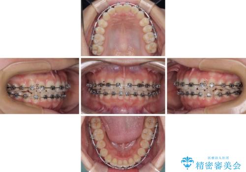 上下前歯のデコボコ ワイヤー装置で楽して改善の治療中