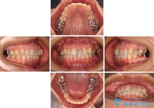 気になる下顎歯列のみをインビザラインで部分矯正の治療中