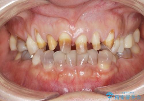 [ テトラサイクリン歯 ] 長年気になっていた変色歯を改善の治療中
