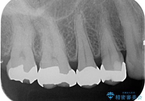 歯が欠けた 金属による割れない修復の治療後