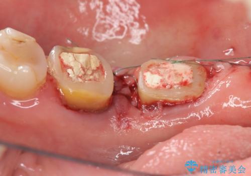 歯周病の歯を残すための再生治療の治療前