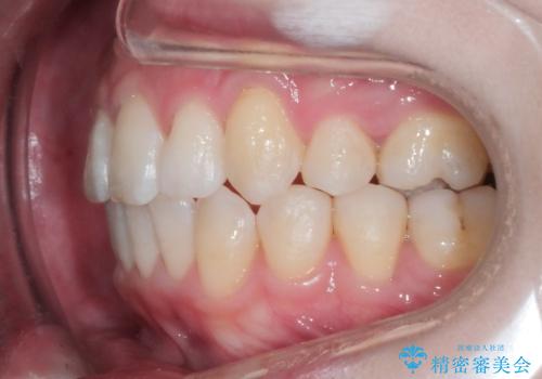 ワイヤー矯正　抜歯本数を最小限にし、八重歯のない歯並びに　の治療後