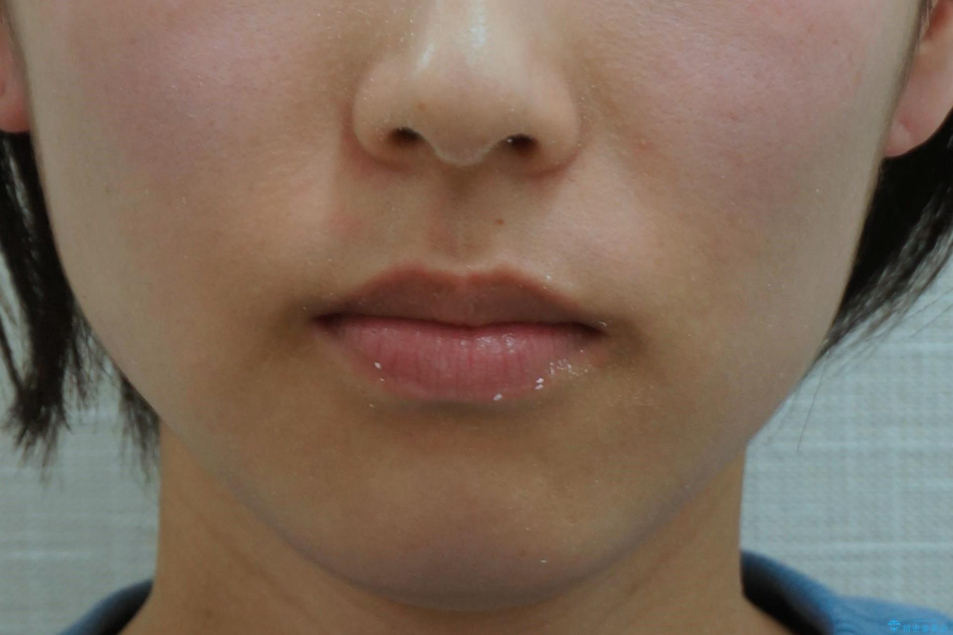 やや難ケース 上の歯を抜かずに歯列を後ろに下げて治療 4本ではなく下1本のみの抜歯できれいにの治療後(顔貌)