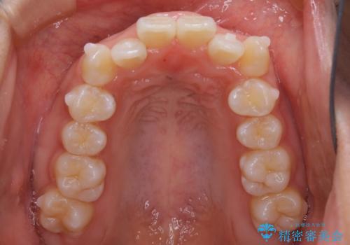 インビザライン矯正 短期間でがたつきのない歯並びに!の治療中