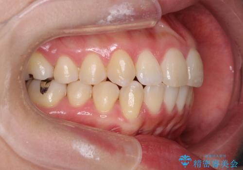 不安定な噛み合わせを改善 マウスピース矯正治療の治療後