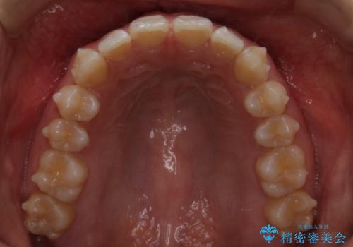 インビザライン矯正 前歯のすきっ歯を治したいの治療中