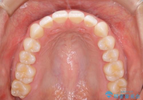 インビザライン矯正 前歯のすきっ歯を治したいの治療後