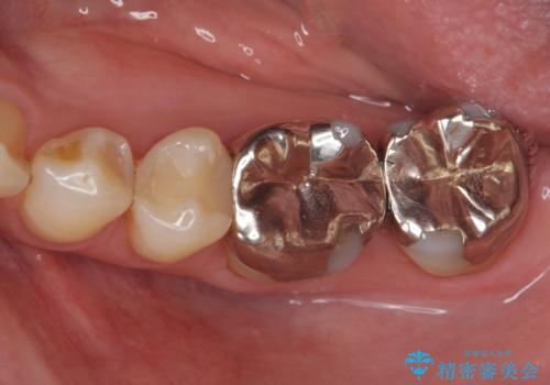 銀歯をセラミック治療で白くの症例 治療前
