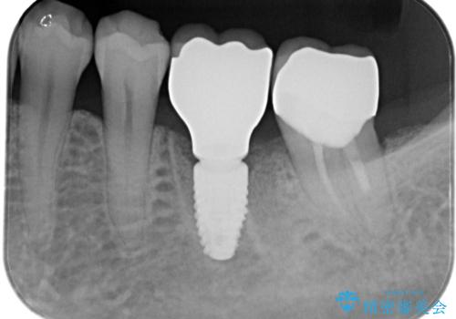 歯の破折　食べる喜びが蘇るインプラント治療の治療後