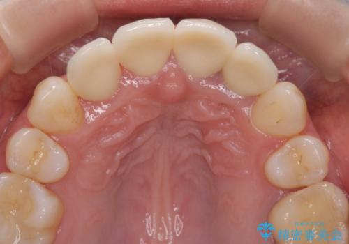 変色した歯を改善、セラミック治療の治療後