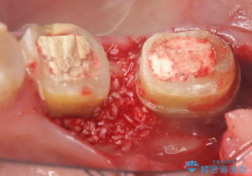 歯周病の歯を残すための再生治療の治療前