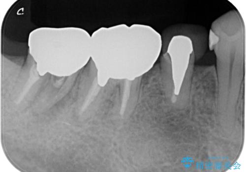 毎食後物がつまる! インプラント治療の治療前
