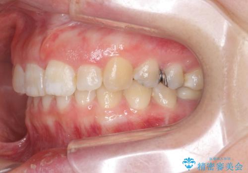 ねじれた前歯を改善するマウスピース矯正の治療後