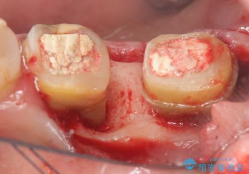 歯周病の歯を残すための再生治療の症例 治療前