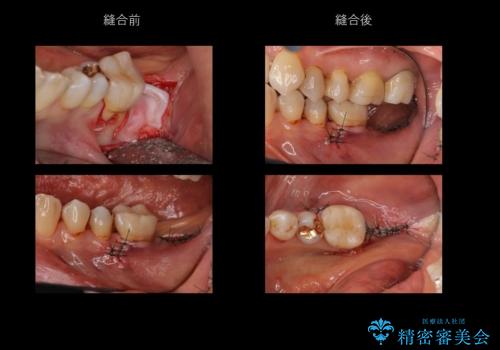奥歯のインプラント 永くもつようにの治療中