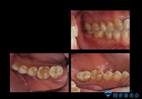 奥歯の高さがない 歯周外科で解決の治療前