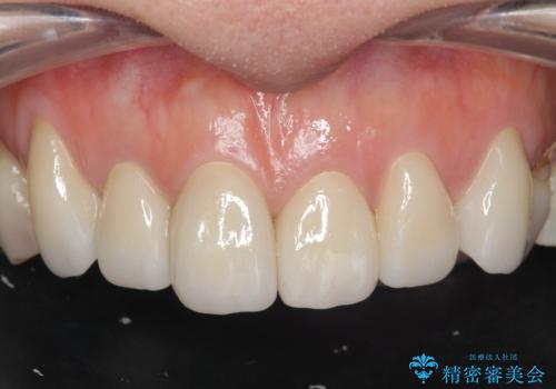 [ テトラサイクリン歯 ] 長年気になっていた変色歯を改善の治療後