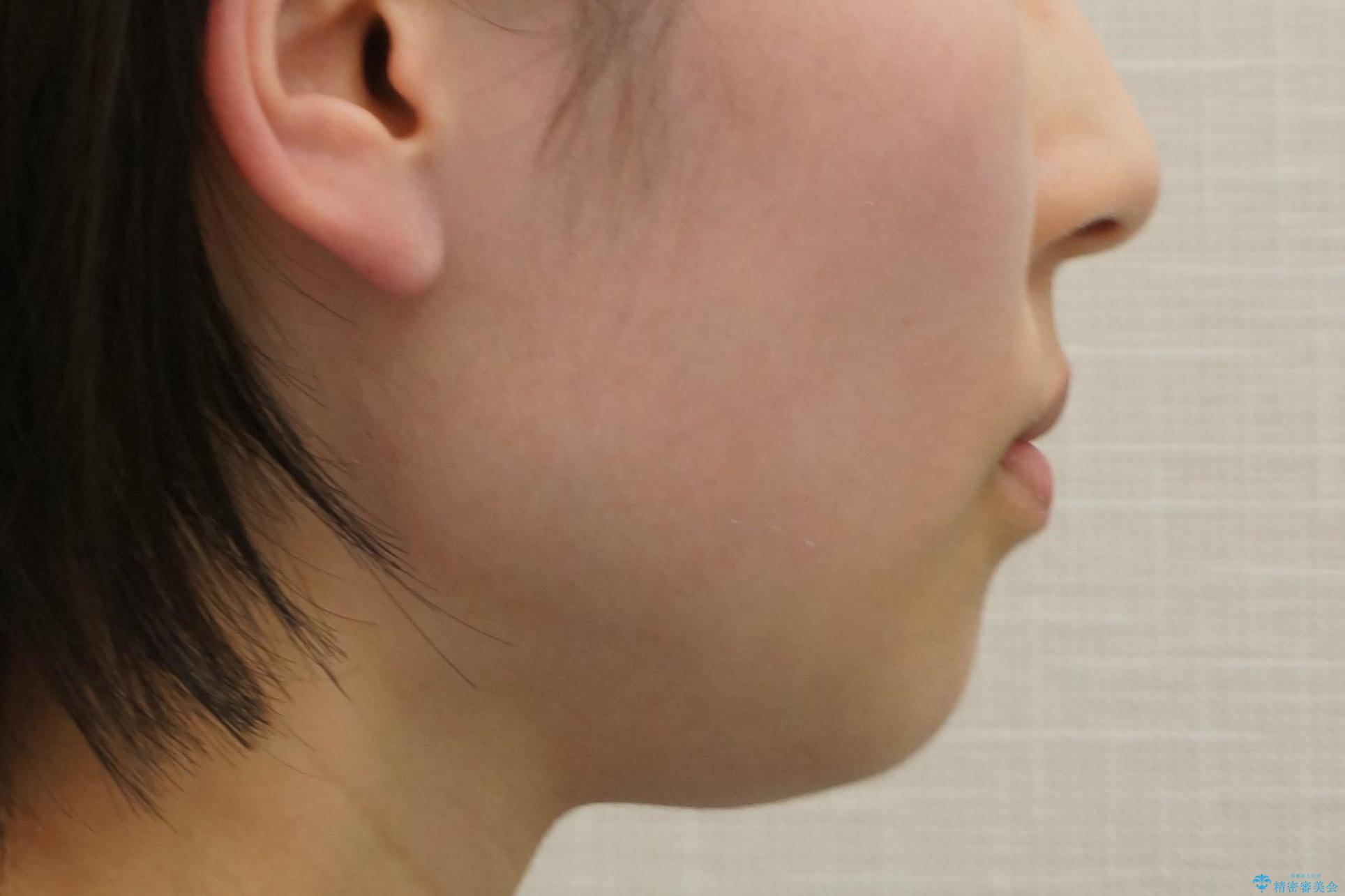 やや難ケース 上の歯を抜かずに歯列を後ろに下げて治療 4本ではなく下1本のみの抜歯できれいにの治療後(顔貌)