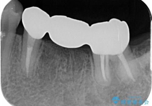 奥歯の高さがない 20代で入れ歯もインプラントも難しい ブリッジで歯を残す治療の治療後
