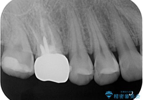 歯の間に食べ物がよく挟まるのを治したいの治療前