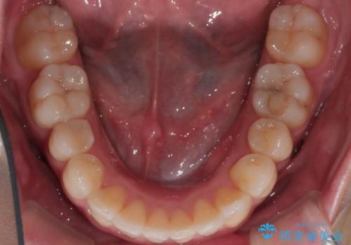 ワイヤー矯正　抜歯本数を最小限にし、八重歯のない歯並びに　の治療後