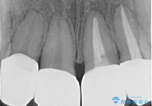 変色した歯を改善、セラミック治療の治療後