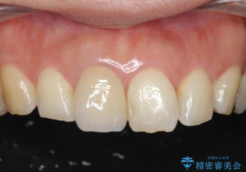 折れてしまった前歯   オールセラミックによる審美改善の治療後