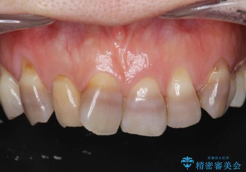 [ テトラサイクリン歯 ] 長年気になっていた変色歯を改善の症例 治療前